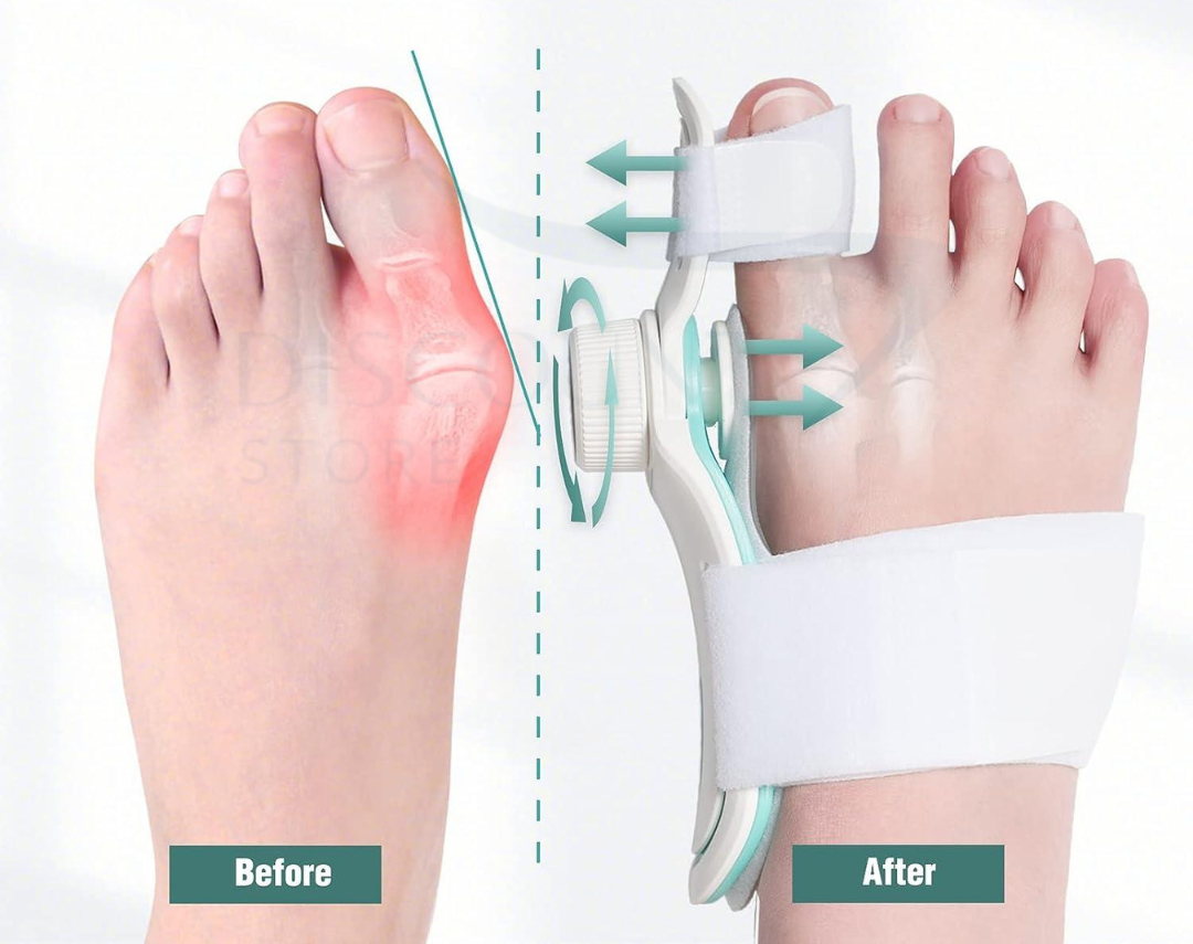 Pain Relief Bunion Toe Corrector™ - (IMPORTED)